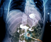 Feeding tube in motor neurone disease,X-ray