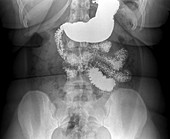 Stomach in bariatric surgery,X-ray