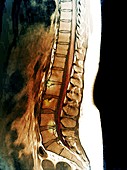 Herniated disks in sciatica,MRI