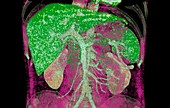Abdominal organs,coloured CT scan