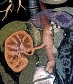 Kidney in Marfan syndrome,CT scan