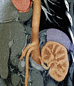 Kidney in Marfan syndrome,CT scan