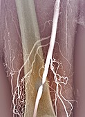 Nearly blocked femoral artery,angiogram