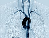 Chest and neck arteries,digital angiogram