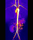 Torso arteries,digital angiogram