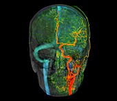 Brain blood vessels,3D angiogram