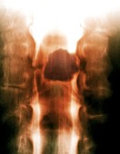 Spinal cord tumour,X-ray myelography image