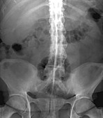 Spine in ankylosing spondylitis,X-ray