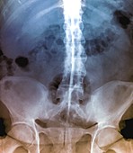 Spine in ankylosing spondylitis,X-ray