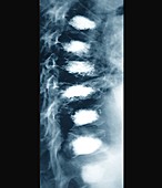 Osteoporosis of the spine with vertebroplasty,X-ray
