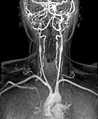 Cervical artery dissections,MRI angiogram