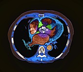 Heart failure,axial CT scan