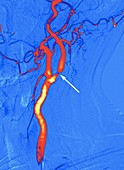 Narrowed carotid artery,digital angiogram