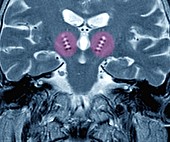 Parkinson's disease electrode implants,MRI brain scan