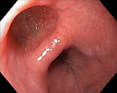 Oesophageal diverticulum,endoscopy image