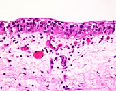 Urothelial carcinoma-in-situ,light micrograph