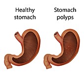 Stomach polyps and healthy stomach,illustration
