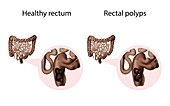 Rectal polyps and healthy rectum,illustration