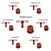 Cervical diseases and healthy cervix,illustration