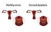 Cervical dysplasia and healthy cervix,illustration