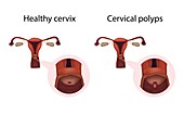 Cervical polyps and healthy cervix,illustration