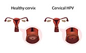 Cervical HPV infection and healthy cervix,illustration