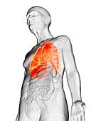 Illustration of an elderly man's lung