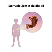 Stomach ulcer in childhood,illustration