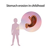 Stomach erosion in childhood,illustration