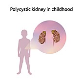 Polycystic kidney in childhood,illustration