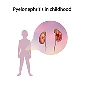Pyelonephritis in childhood,illustration