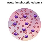 Acute lymphocytic leukaemia,illustration