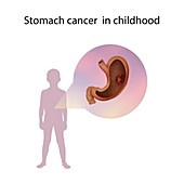 Stomach cancer in childhood,illustration