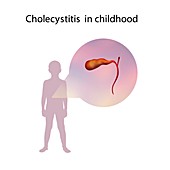 Cholecystitis in childhood,illustration