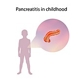 Pancreatitis in childhood,illustration