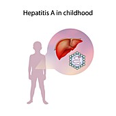 Hepatitis A in childhood,illustration