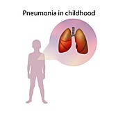 Pneumonia in childhood,illustration