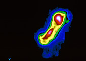 Stomach filling in dyspepsia: 10min,gamma scan