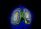 F/colour gamma scan of healthy human lungs