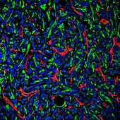 Breast cancer tumour tissue, confocal light micrograph