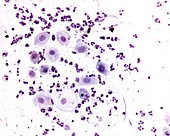 Vaginal smear showing vaginitis, light micrograph