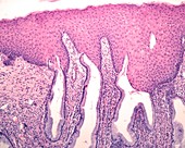 Squamous metaplasia of endocervix, light micrograph