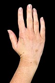 Congenital moles on the hand