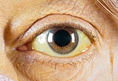 Kayser-Fleischer ring in eye due to liver disease