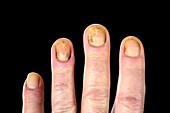 Dystrophic finger nails