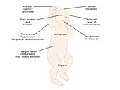 Symptoms of dehydration in babies, illustration