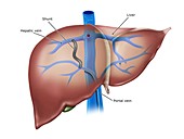 Liver shunt, illustration