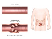 Intussusception of the intestines, illustration