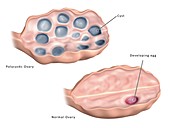 Polycystic ovary, illustration