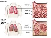 Lung diseases and alveoli, illustration